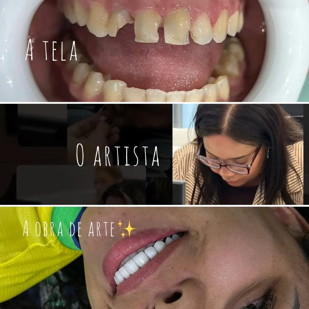 A tela, o artista e a obra de arte: o dente antes, a Dra. Talita trabalhando e o sorriso pronto